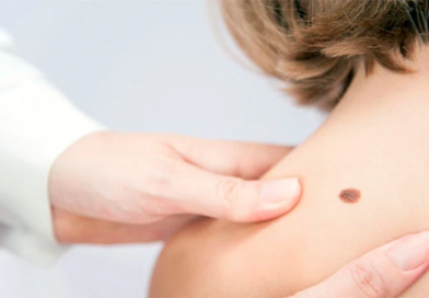 Родинки: «изюминка» внешности или опасное образование кожи?